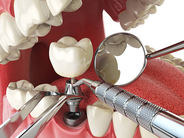 Best Emergency Treatment for Toothache in Affton, MO